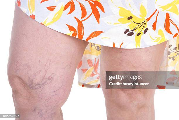 varicose vein - varicose vein stock pictures, royalty-free photos & images