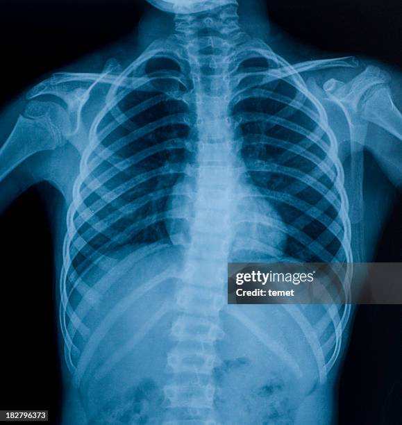 x-ray image of chest - borstkas stockfoto's en -beelden