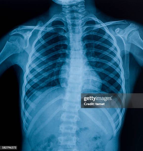 x-ray image of chest - röntgenbild bildbanksfoton och bilder