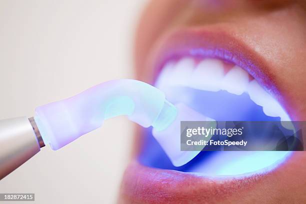 dental filling drying - dental filling stockfoto's en -beelden