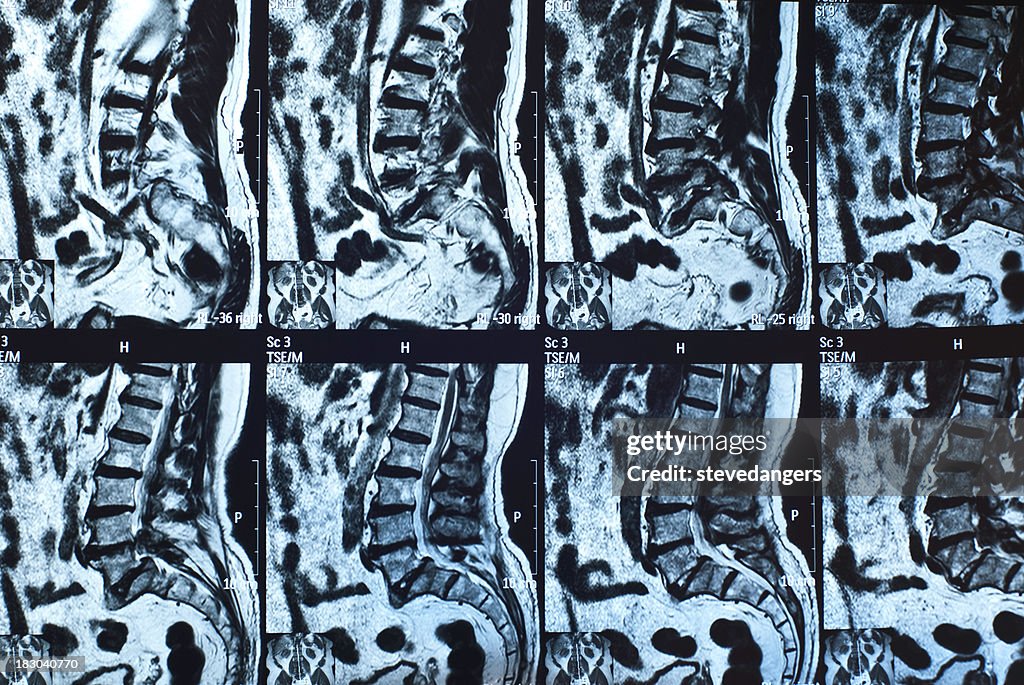 Baja espalda MRI