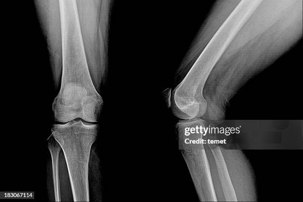 knie - femur stock-fotos und bilder