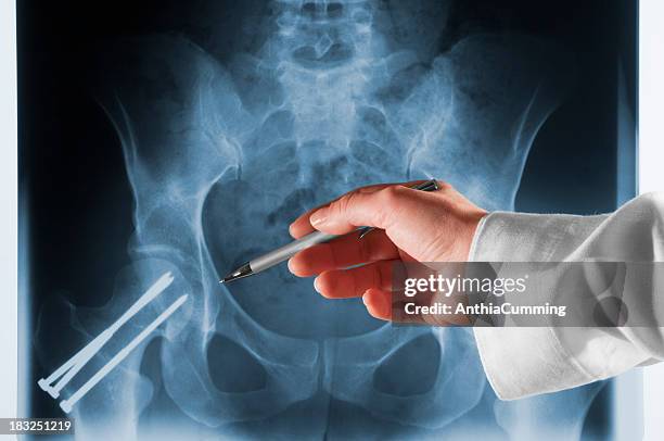 doctor pointing at x-ray of pelvis with screws in hip joint - heup stockfoto's en -beelden