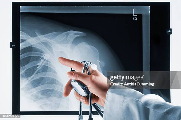 arzt zeigt auf xray mit stethoskop in der hand - verrenkung stock-fotos und bilder