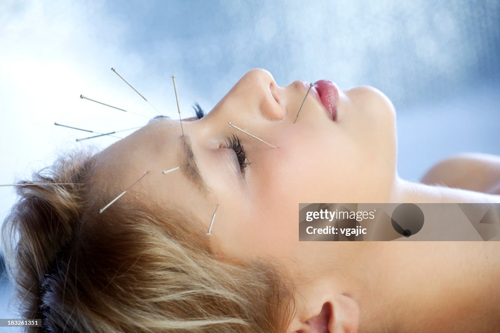 Acupuncture treatment