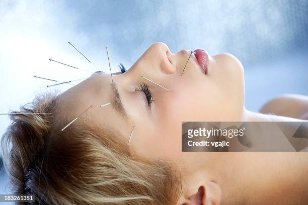 acupuncture treatment - acupuncture needle 個照片及圖片檔