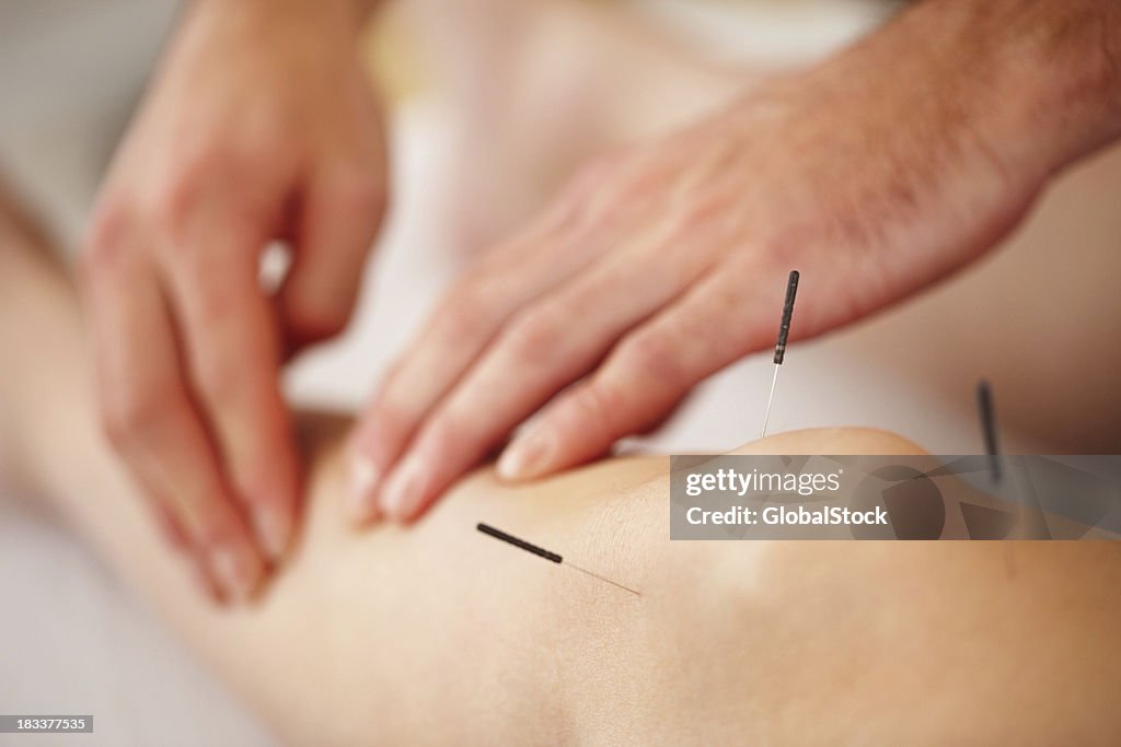 Femme avec un traitement d'acupuncture