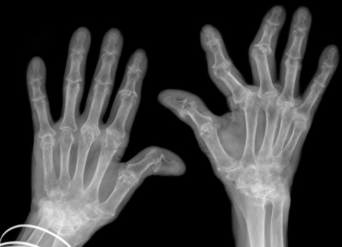 hand xrays showing advanced rheumatoid arthritis