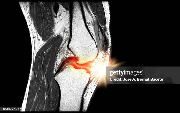 magnetic resonance imaging mri knee with pain simulation. - meniscus stock pictures, royalty-free photos & images