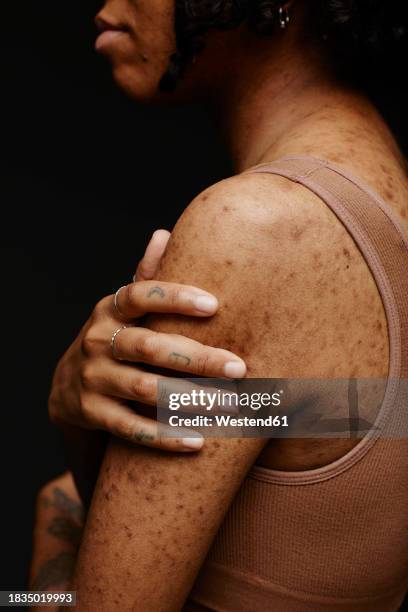 young woman with acne scars against black background - cicatriz fotografías e imágenes de stock