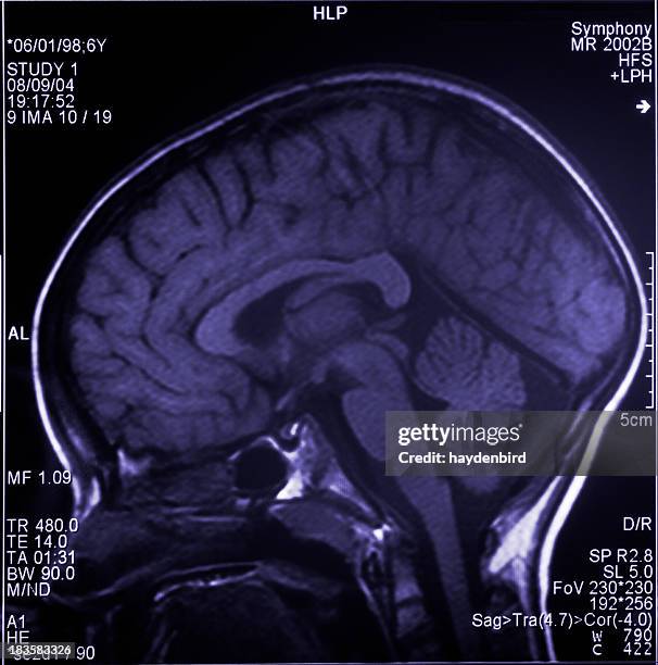 mri brain scan showing multiple images of head and skull - mri brain tumor stock pictures, royalty-free photos & images
