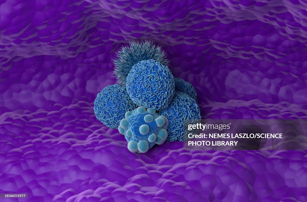 Pancreatic cancer, illustration