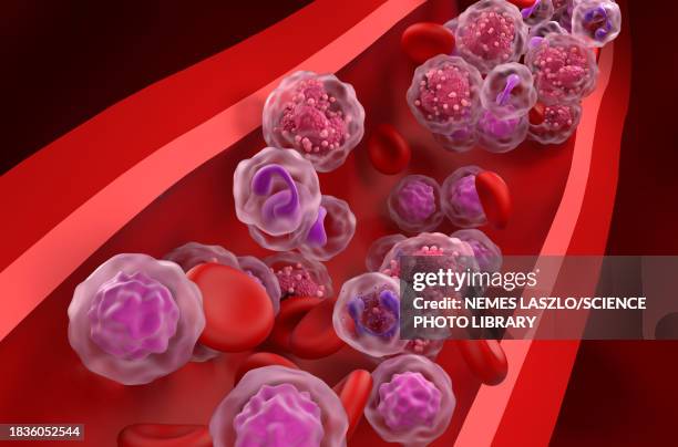 acute lymphoblastic leukemia, illustration - bone marrow stock illustrations