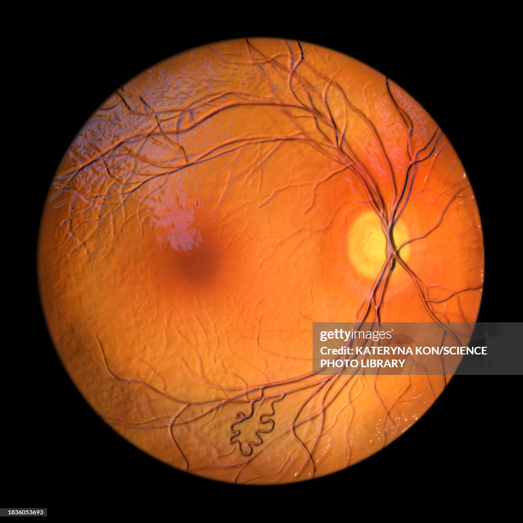 Retinal arteriovenous malformation, illustration