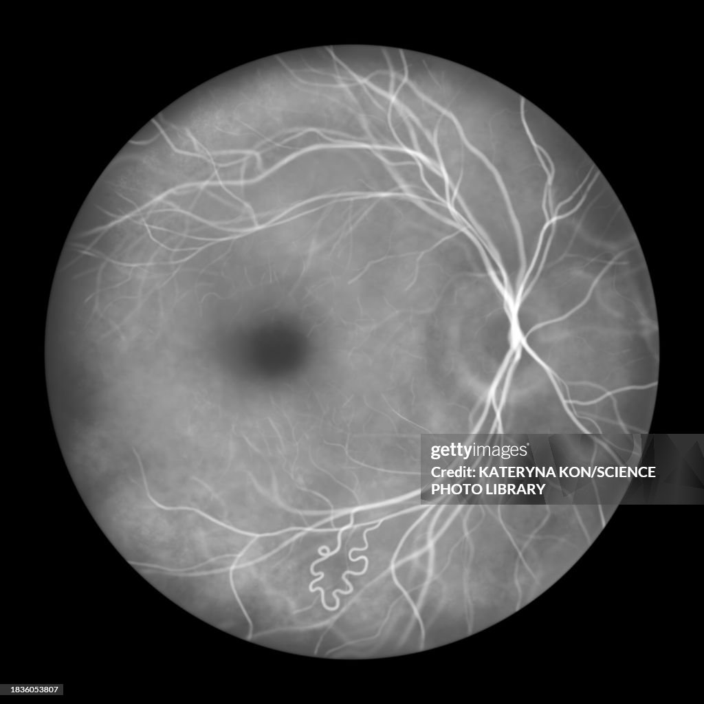 Retinal arteriovenous malformation, illustration