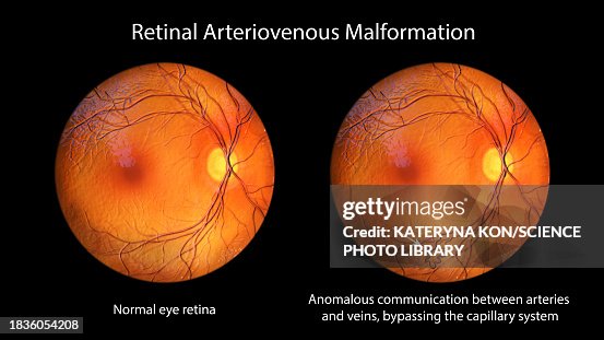 Avm Gi Retinal Arteriovenous Malformation Illustration High-Res Vector Graphic ...