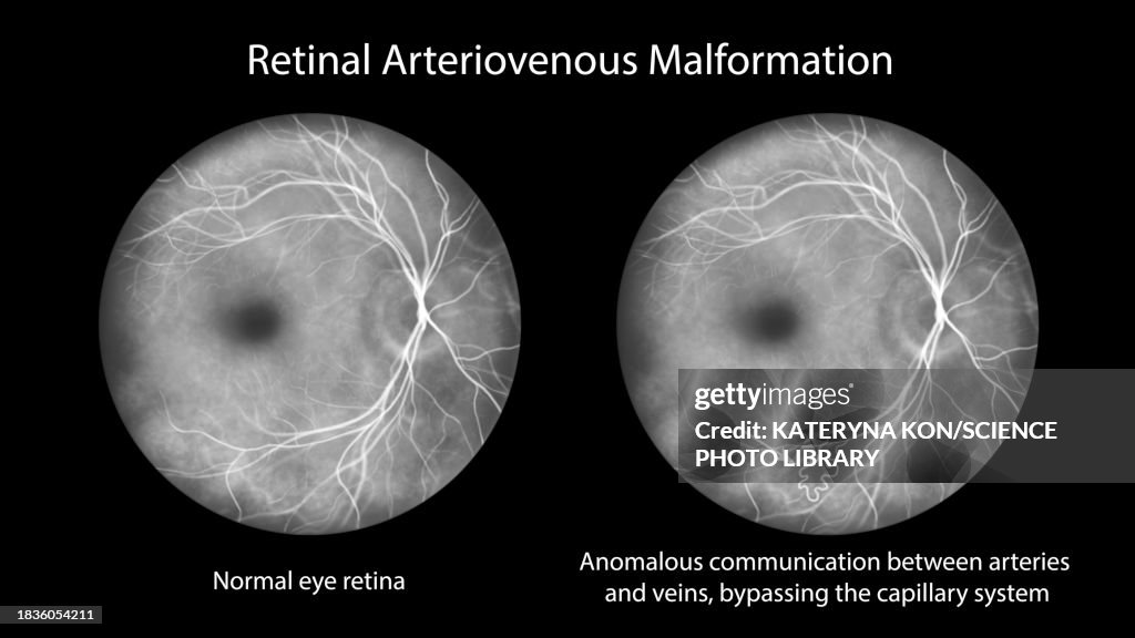 Retinal arteriovenous malformation, illustration