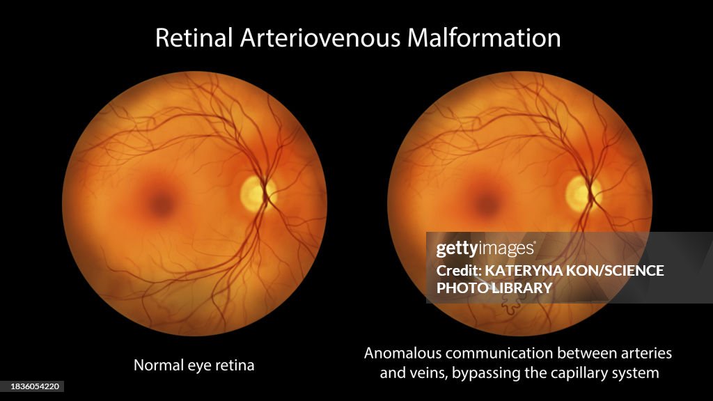 Retinal arteriovenous malformation, illustration