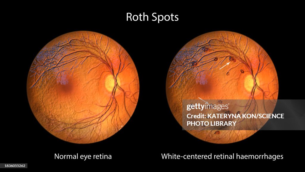 Allen Roth Spouts Roth Spots In The Retina Illustration High-Res Vector Graphic - Getty ...