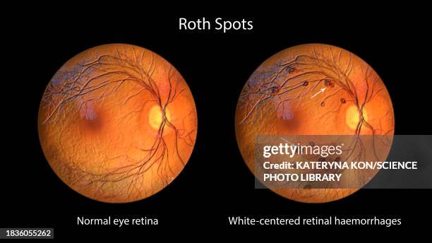 Single Roth Spots Diabetes Roth Spots In The Retina Illustration High-Res Vector Graphic - Getty ...