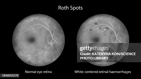 Macular Roth Spot Roth Spots In The Retina Illustration High-Res Vector Graphic - Getty ...