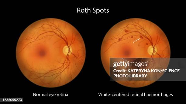 roth spots in the retina, illustration - lupus stock-grafiken, -clipart, -cartoons und -symbole