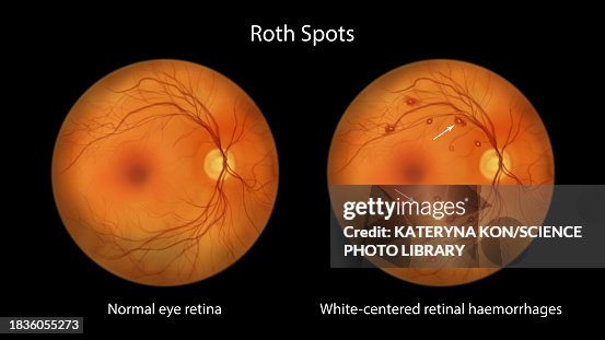 Old Roth Spots Roth Spots In The Retina Illustration High-Res Vector Graphic - Getty ...