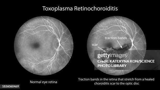 toxoplasma retinochoroiditis, illustration - arteriography stock illustrations