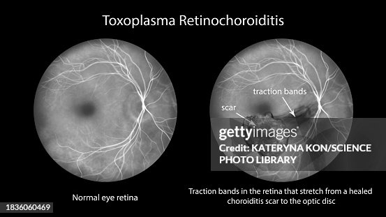 Toxoplasma retinochoroiditis, illustration Toxoplasma retinochoroiditis, illustration