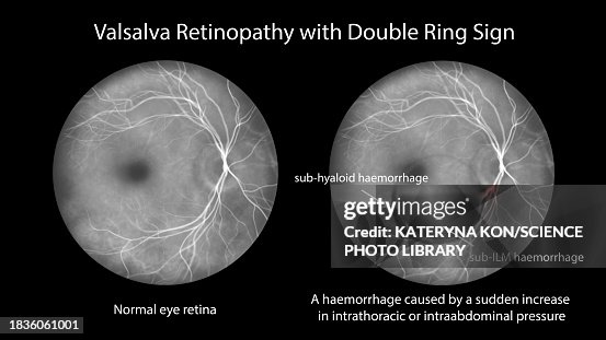 Valsava retinopathy, illustration Valsava retinopathy, illustration