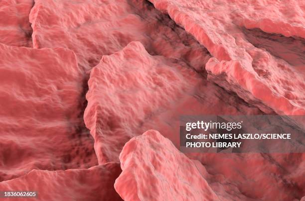 psoriasis, illustration - dermatology stock illustrations