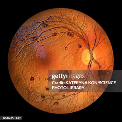 Macular Roth Spot Roth Spots In The Retina Illustration High-Res Vector Graphic - Getty ...