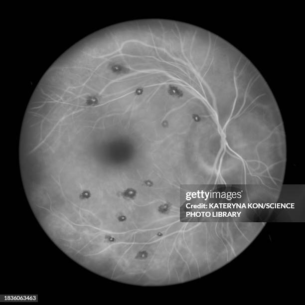 roth spots in the retina, illustration - systemic lupus erythematosus stock illustrations