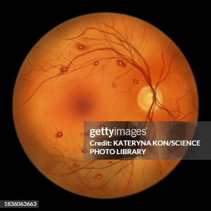 Red Spot Roth Spot Roth Spots In The Retina Illustration High-Res Vector Graphic - Getty ...
