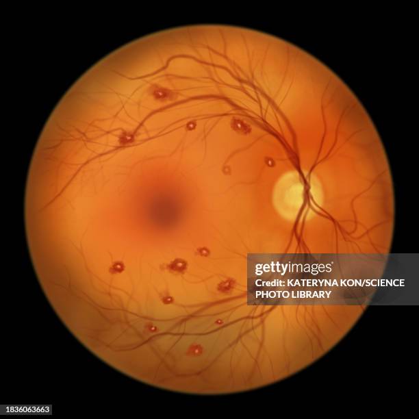 roth spots in the retina, illustration - sepsis stock illustrations