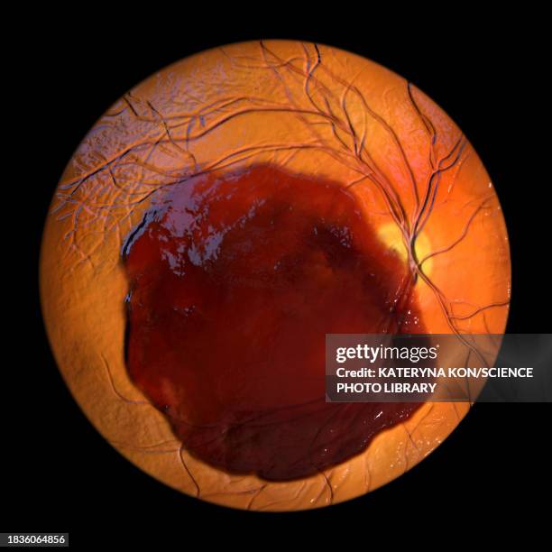 Bleeding Macula 104 Retinal Hemorrhage Stock Photos, High-Res Pictures, and Images ...