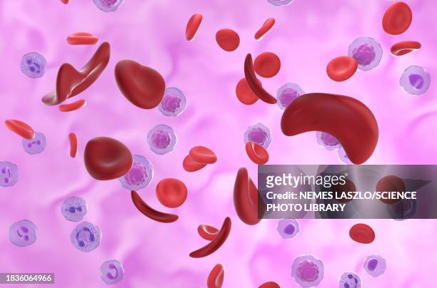 sickle cell anaemia, illustration - sickle cell stock illustrations