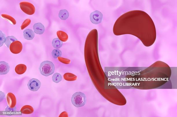 sickle cell anaemia, illustration - sickle cell stock illustrations