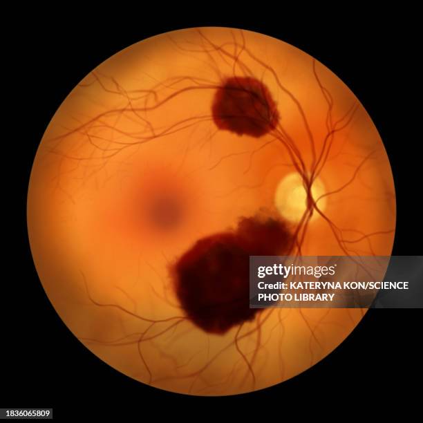 subretinal haemorrhage, illustration - fundus stock illustrations
