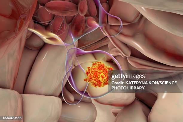 pituitary gland tumour, illustration - human gland stock illustrations