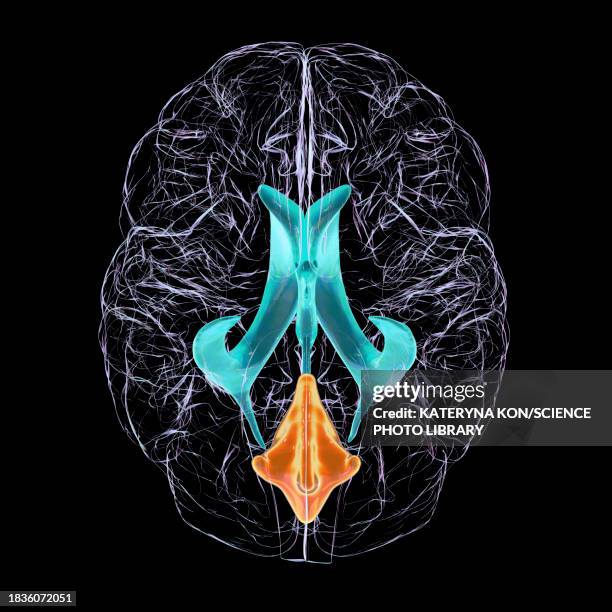 enlarged fourth ventricle of the brain, illustration - brain tumour stock illustrations