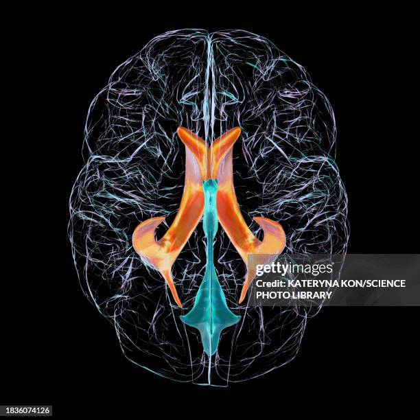 lateral brain ventricles, illustration - hydrocephalus stock illustrations