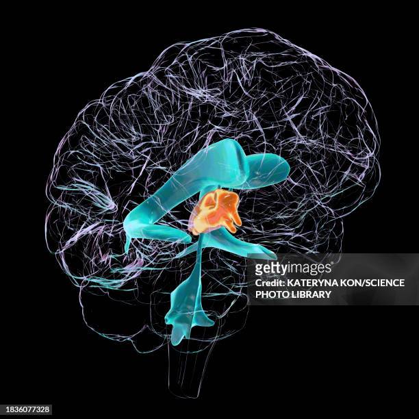 enlarged third ventricle of the brain, illustration - hydrocephalus stock illustrations