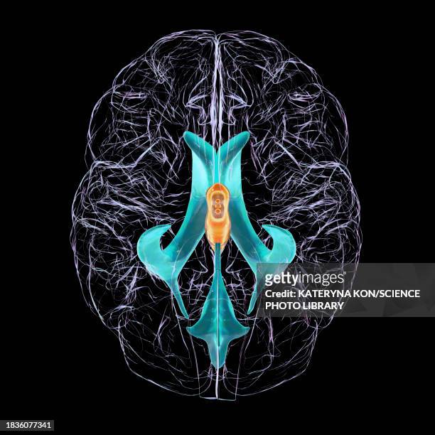 enlarged third ventricle of the brain, illustration - hydrocephalus stock illustrations