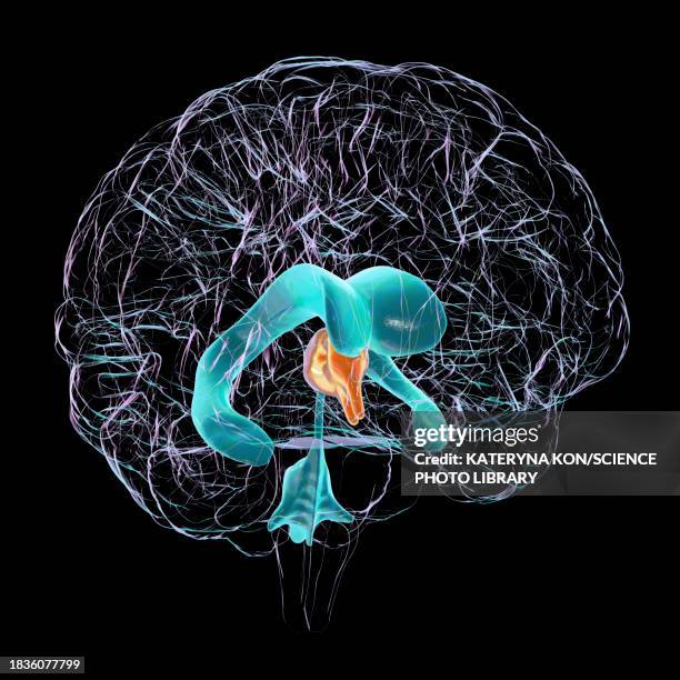 enlarged third ventricle of the brain, illustration - hydrocephalus stock illustrations