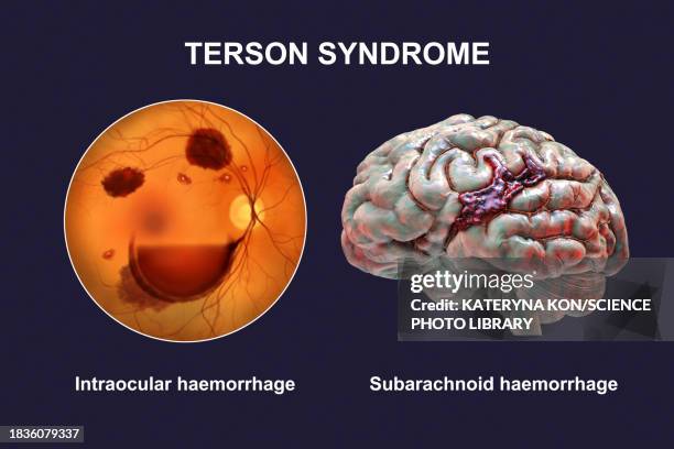 terson syndrome, illustration - concussion stock illustrations