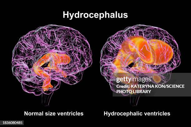 enlarged and normal brain ventricles, illustration - hydrocephalus stock illustrations