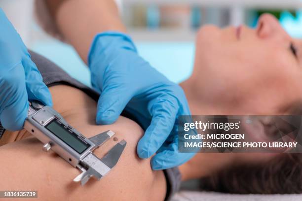dermatologist measuring mole - cancer screening stock pictures, royalty-free photos & images