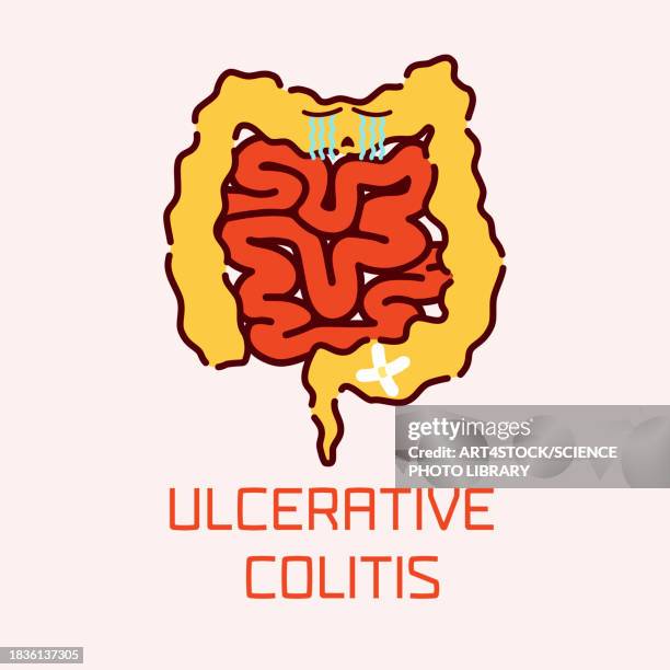 ulcerative colitis, conceptual illustration - displeased stock illustrations