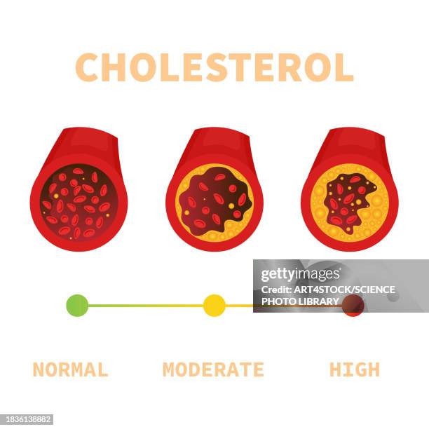 atherosclerosis, conceptual illustration - high density lipoprotein stock illustrations